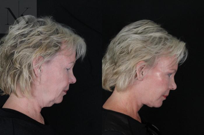 Before & After Deep Plane Facelift Case 167 Right Side Down View in Wethersfield, Hartford, Nebraska