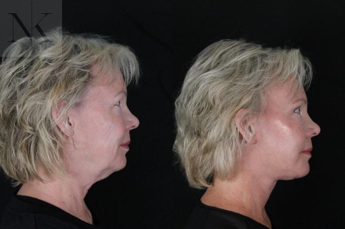 Before & After Deep Plane Facelift Case 167 Right Side View in Wethersfield, Hartford, Nebraska