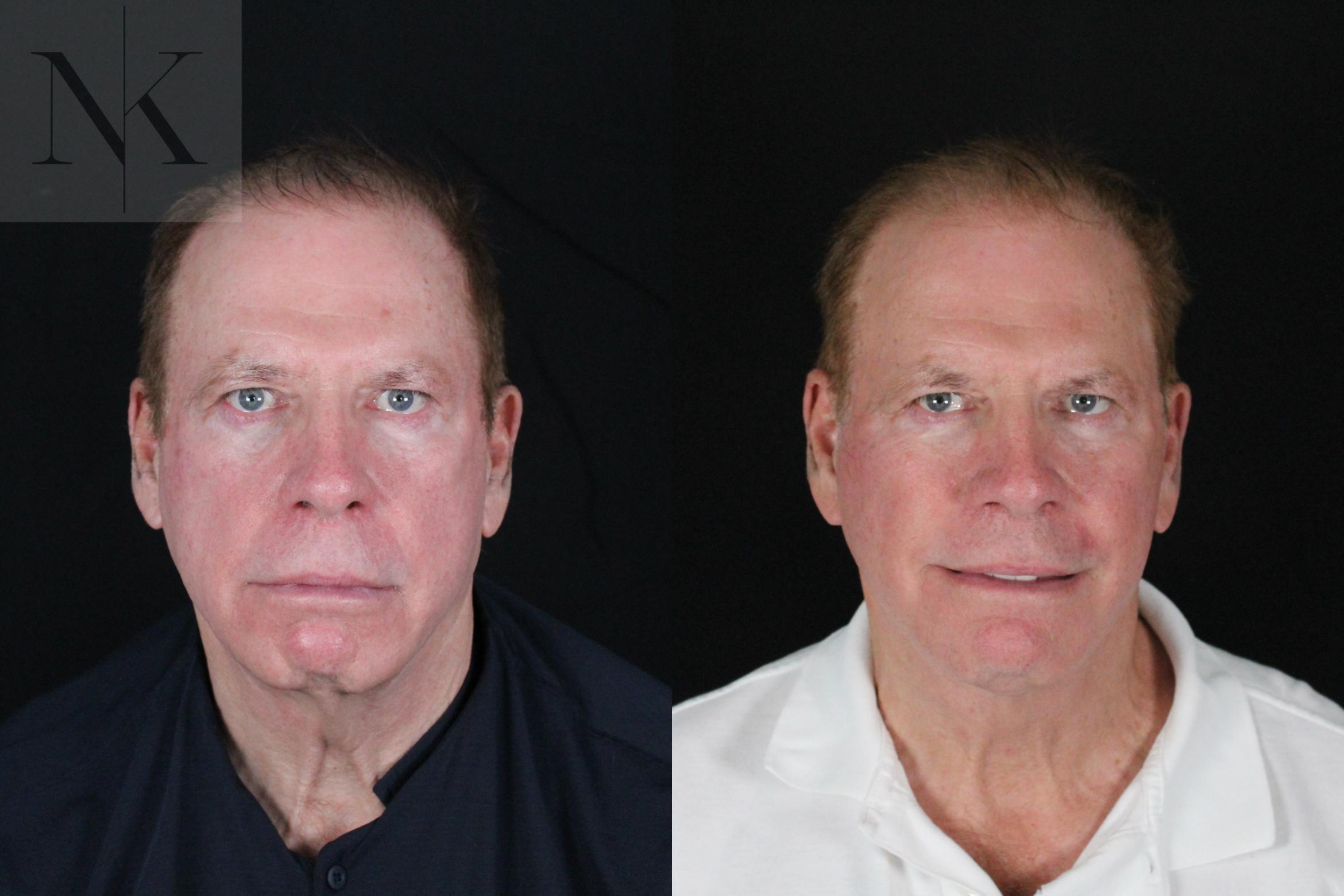 Before & After Deep Plane Facelift Case 168 Front View in Wethersfield, Hartford, Nebraska
