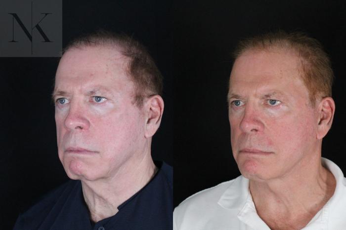 Before & After Deep Plane Facelift Case 168 Left Oblique View in Wethersfield, Hartford, Nebraska