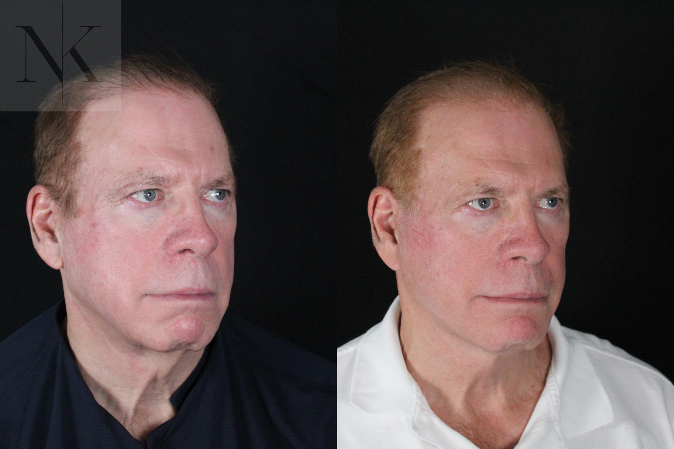 Before & After Deep Plane Facelift Case 168 Right Oblique View in Wethersfield, Hartford, Nebraska