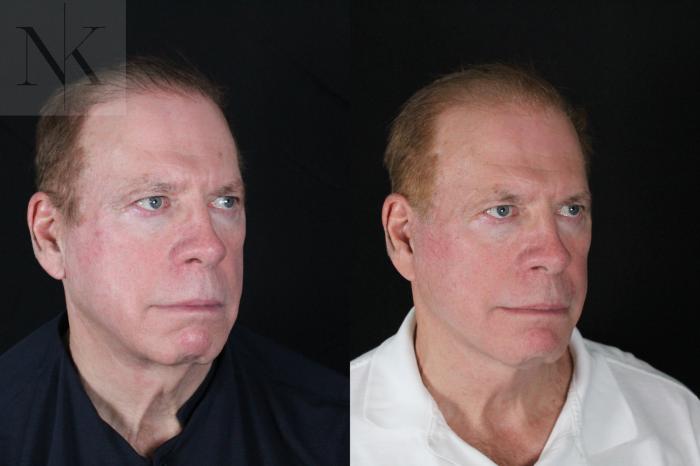 Before & After Deep Plane Facelift Case 168 Right Oblique View in Wethersfield, Hartford, Nebraska