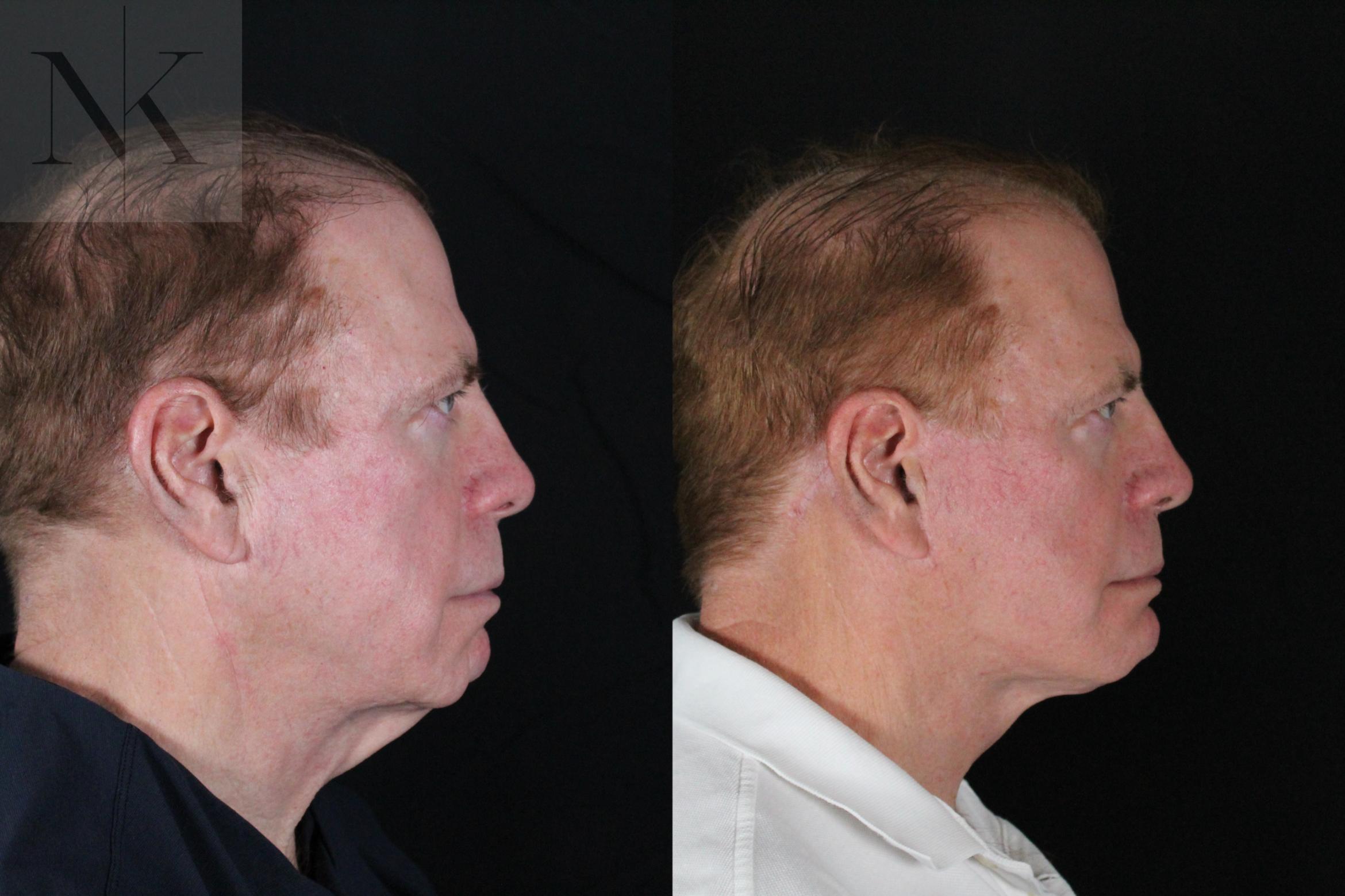 Before & After Deep Plane Facelift Case 168 Right Side View in Wethersfield, Hartford, Nebraska