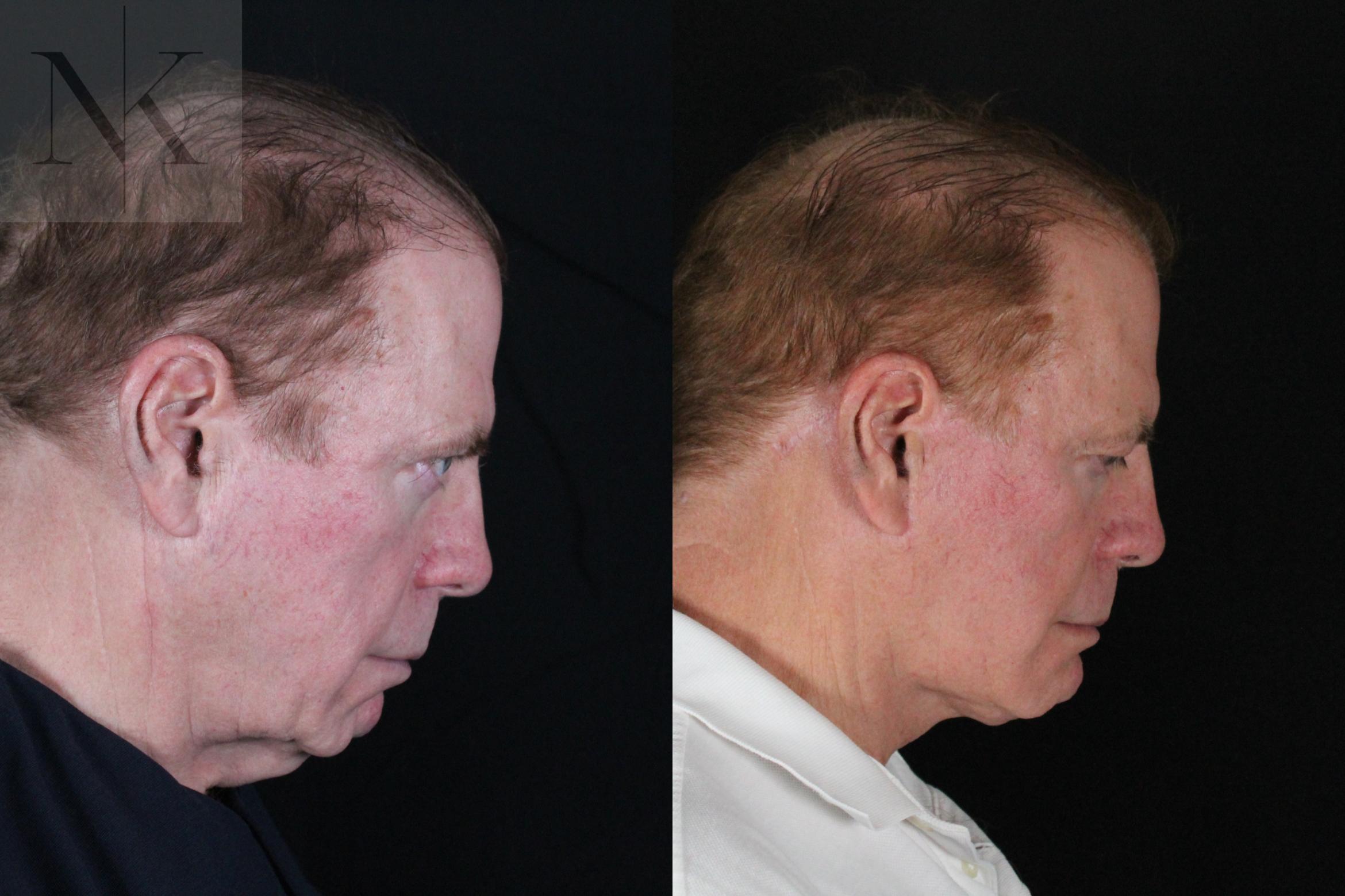 Before & After Deep Plane Facelift Case 168 Right Side Down View in Wethersfield, Hartford, Nebraska