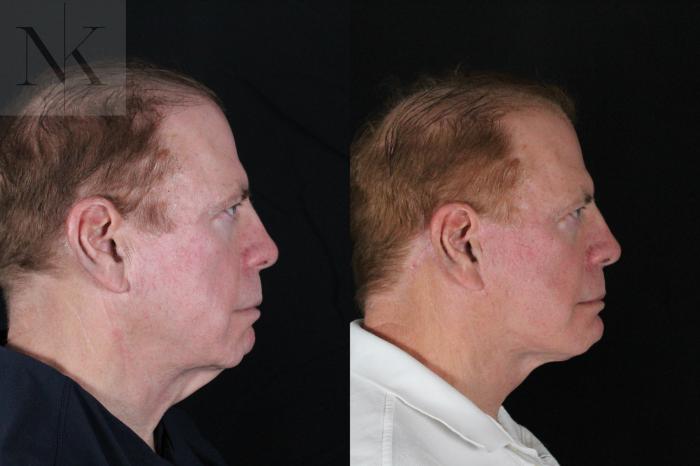 Before & After Deep Plane Facelift Case 168 Right Side View in Wethersfield, Hartford, Nebraska
