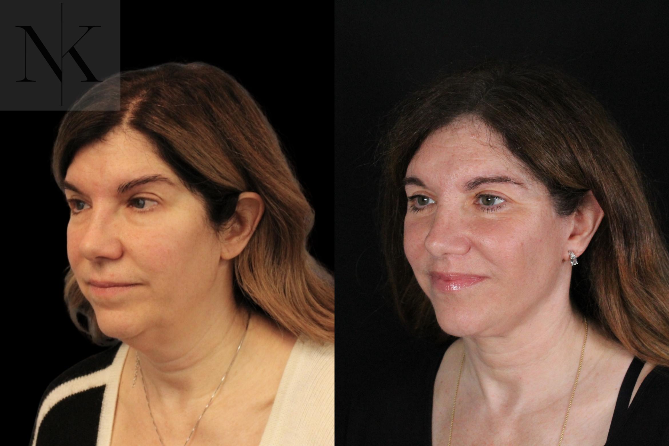 Before & After Lip Lift Case 171 Left Oblique View in Wethersfield, Hartford, Nebraska