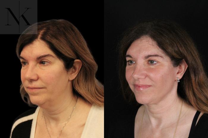 Before & After Lip Lift Case 171 Left Oblique View in Wethersfield, Hartford, Nebraska