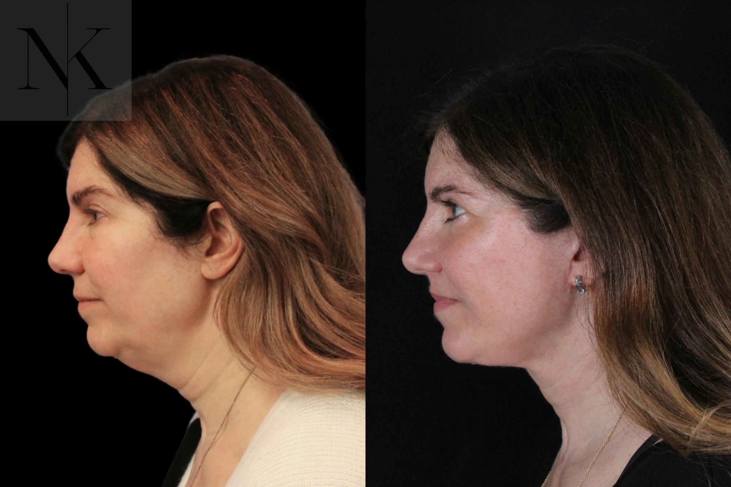 Before & After Deep Plane Facelift Case 171 Left Side View in Wethersfield, Hartford, Nebraska