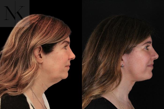 Before & After Lip Lift Case 171 Right Side View in Wethersfield, Hartford, Nebraska