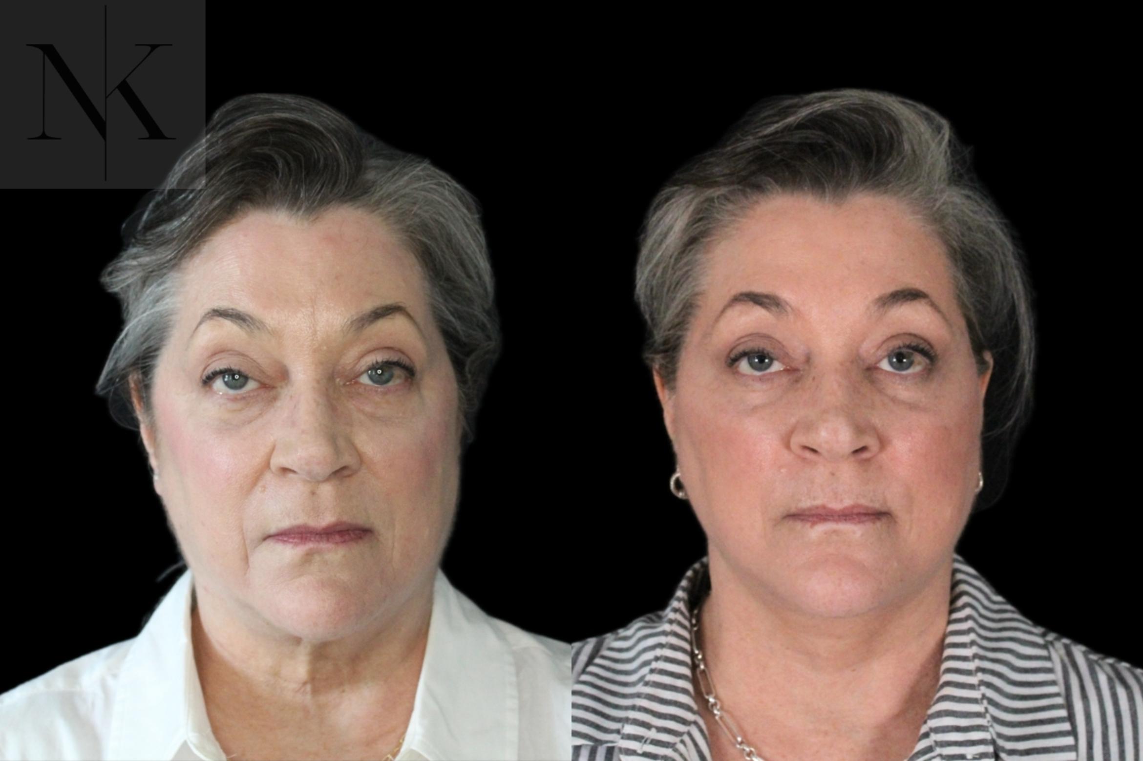 Before & After Deep Plane Facelift Case 178 Front View in Wethersfield, Hartford, Nebraska