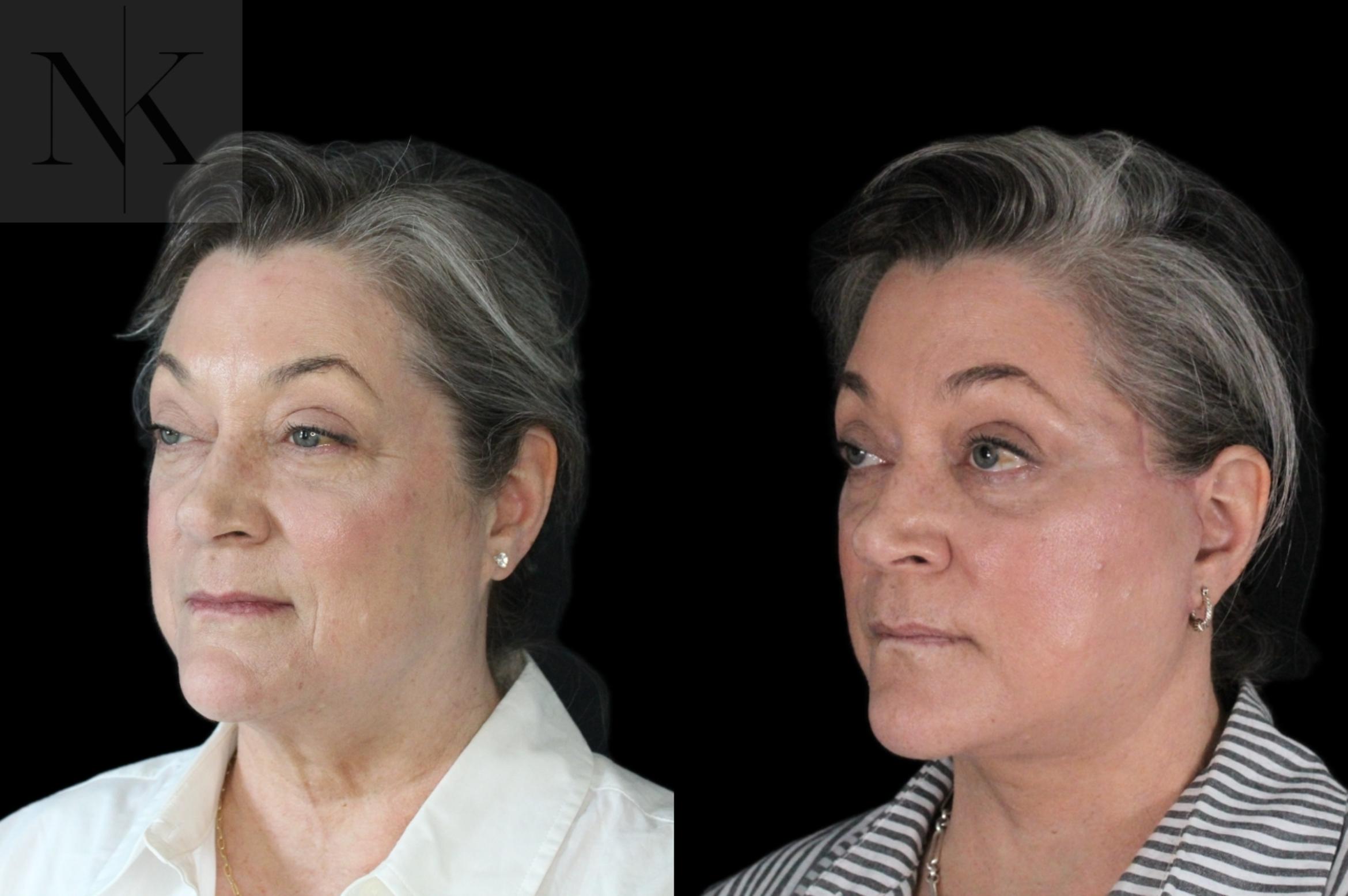 Before & After Deep Plane Facelift Case 178 Left Oblique View in Wethersfield, Hartford, Nebraska