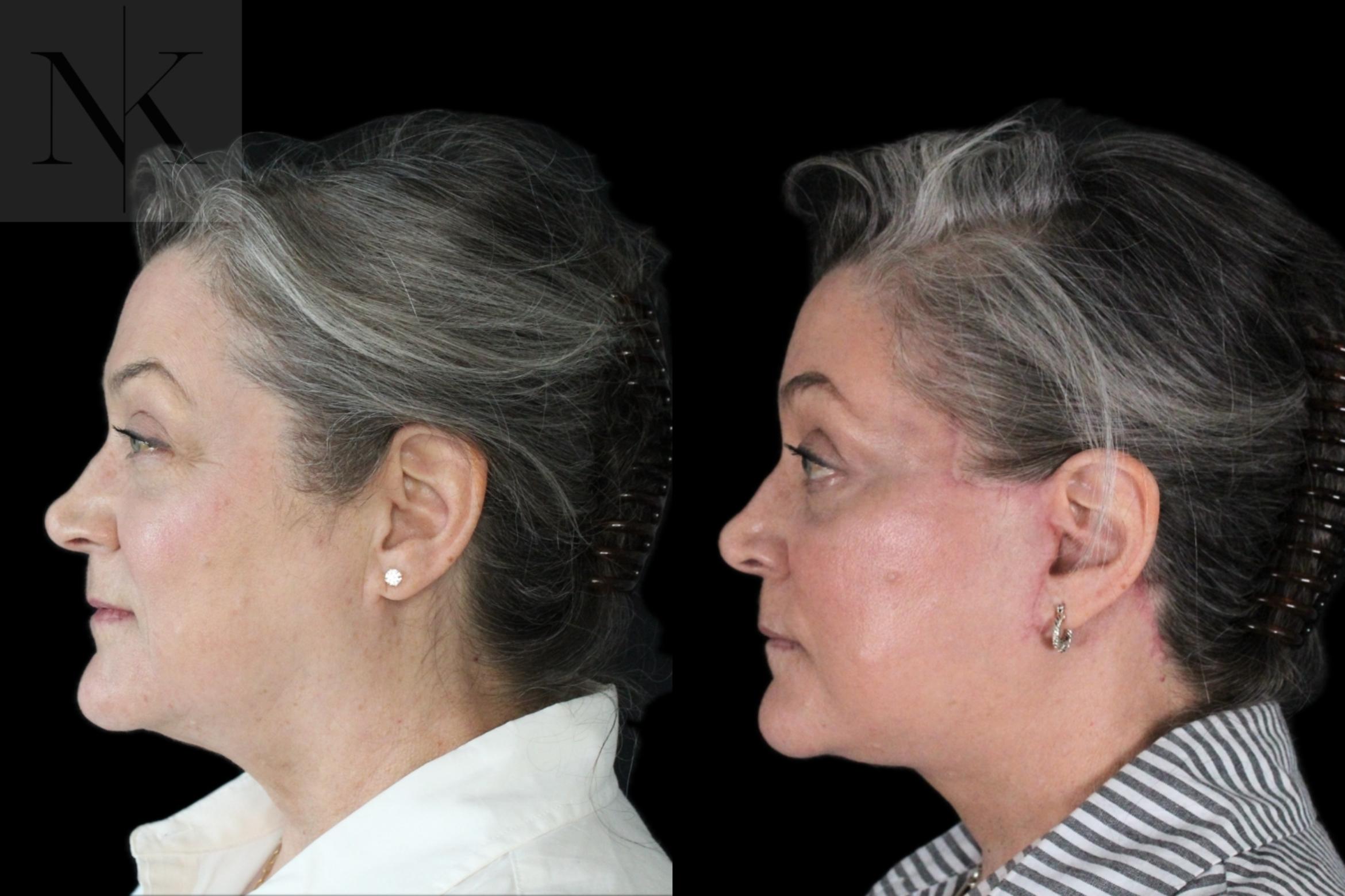 Before & After Deep Plane Facelift Case 178 Left Side View in Wethersfield, Hartford, Nebraska