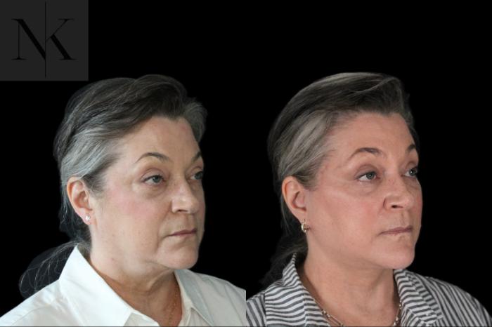 Before & After Deep Plane Facelift Case 178 Right Oblique View in Wethersfield, Hartford, Nebraska