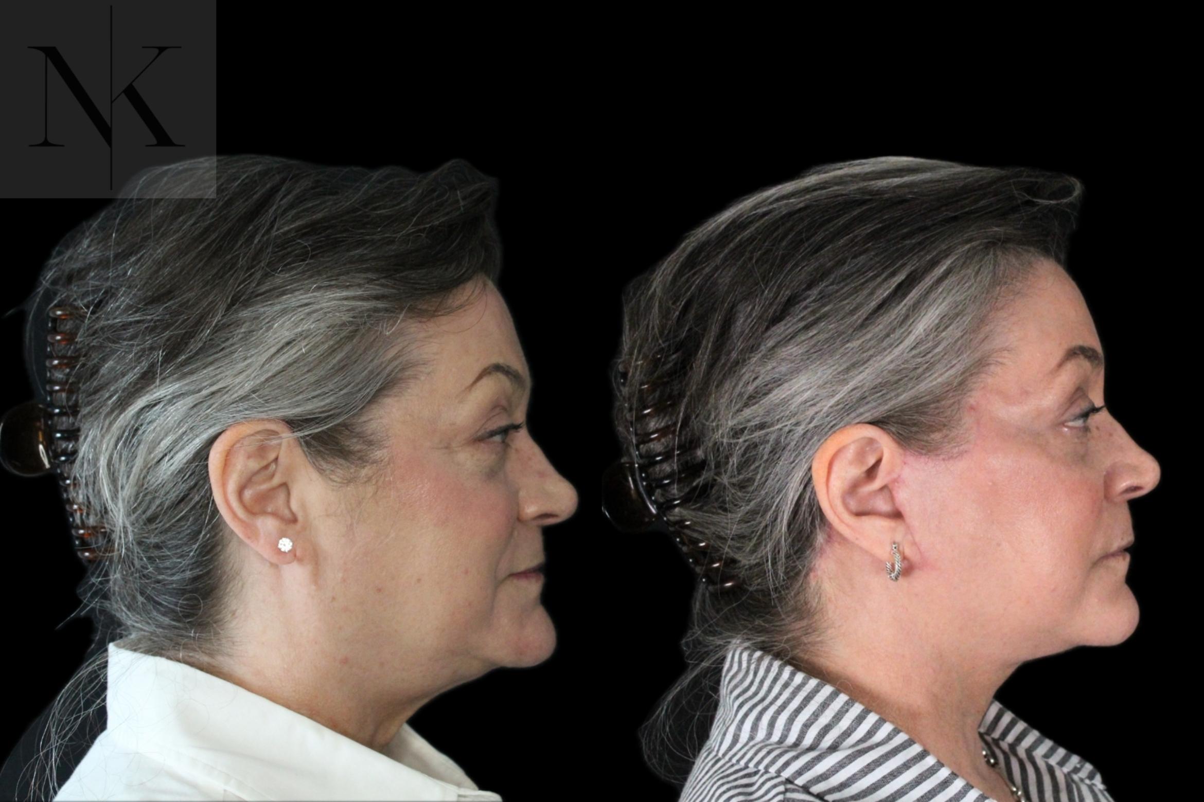 Before & After Deep Plane Facelift Case 178 Right Side View in Wethersfield, Hartford, Nebraska