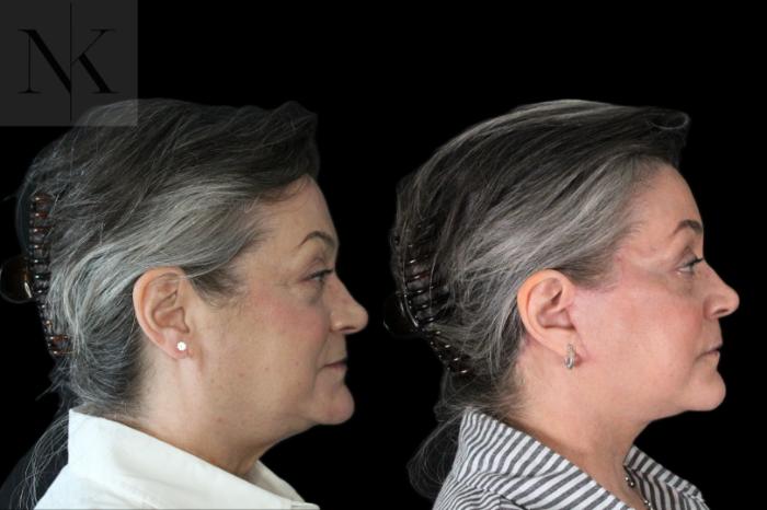 Before & After Deep Plane Facelift Case 178 Right Side View in Wethersfield, Hartford, Nebraska