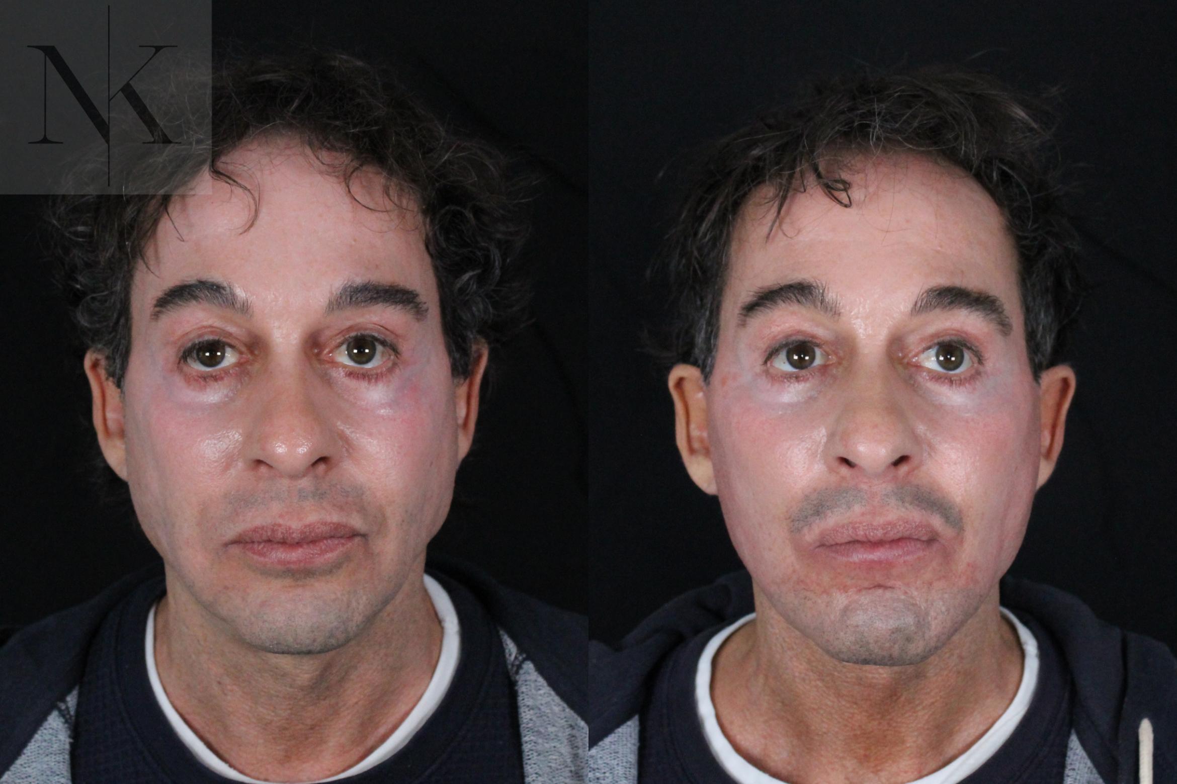 Before & After Deep Plane Facelift Case 189 Front View in Wethersfield, Hartford, Nebraska