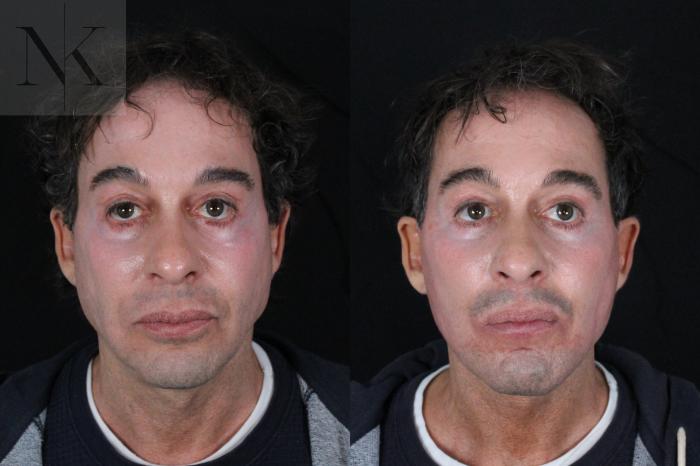 Before & After Deep Plane Facelift Case 189 Front View in Wethersfield, Hartford, Nebraska