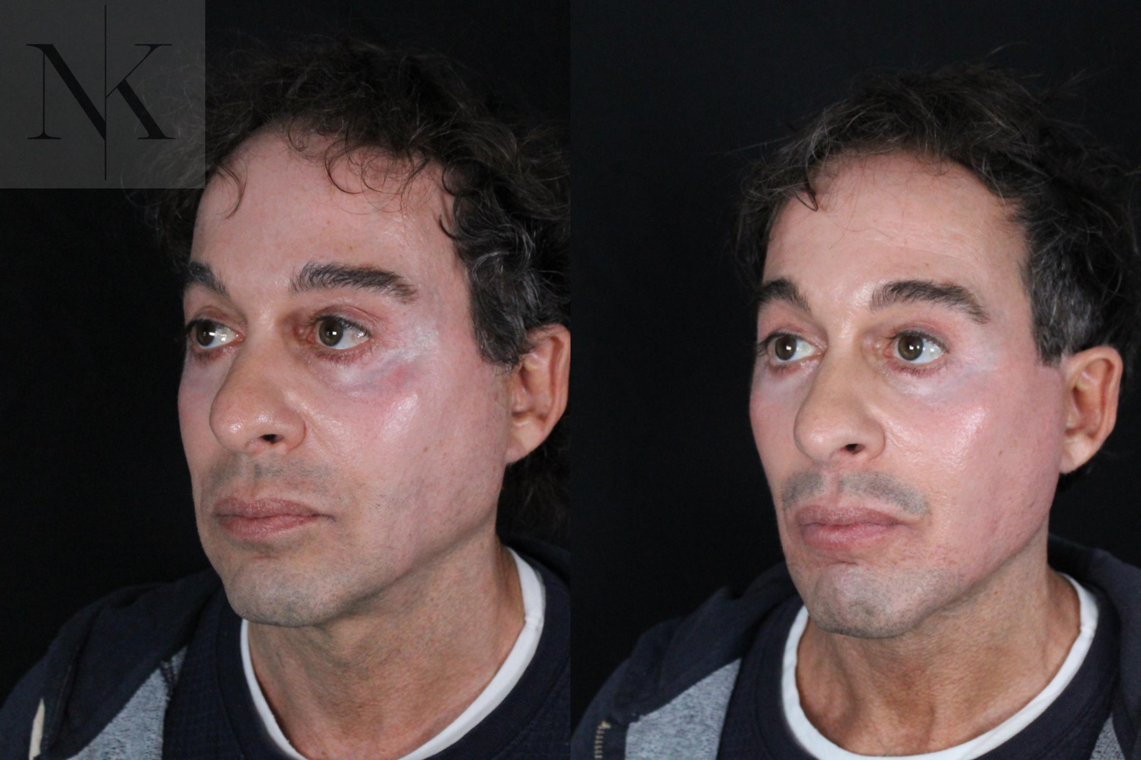 Before & After Deep Plane Facelift Case 189 Left Oblique View in Wethersfield, Hartford, Nebraska