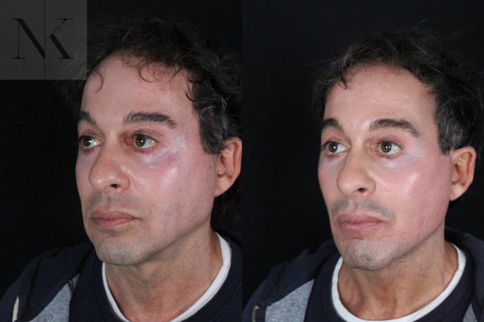 Before & After Deep Plane Facelift Case 189 Left Oblique View in Wethersfield, Hartford, Nebraska