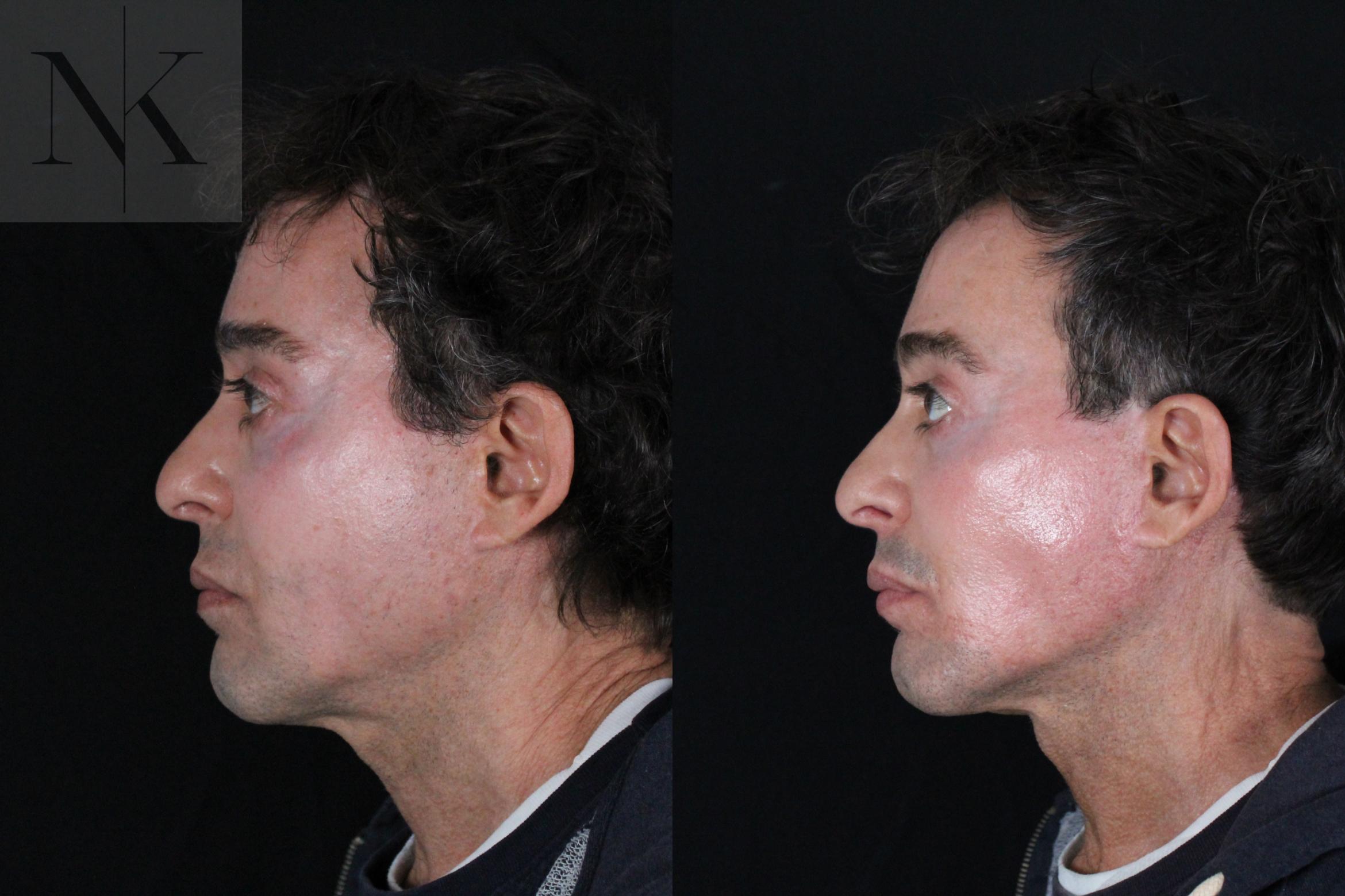 Before & After Deep Plane Facelift Case 189 Left Side View in Wethersfield, Hartford, Nebraska
