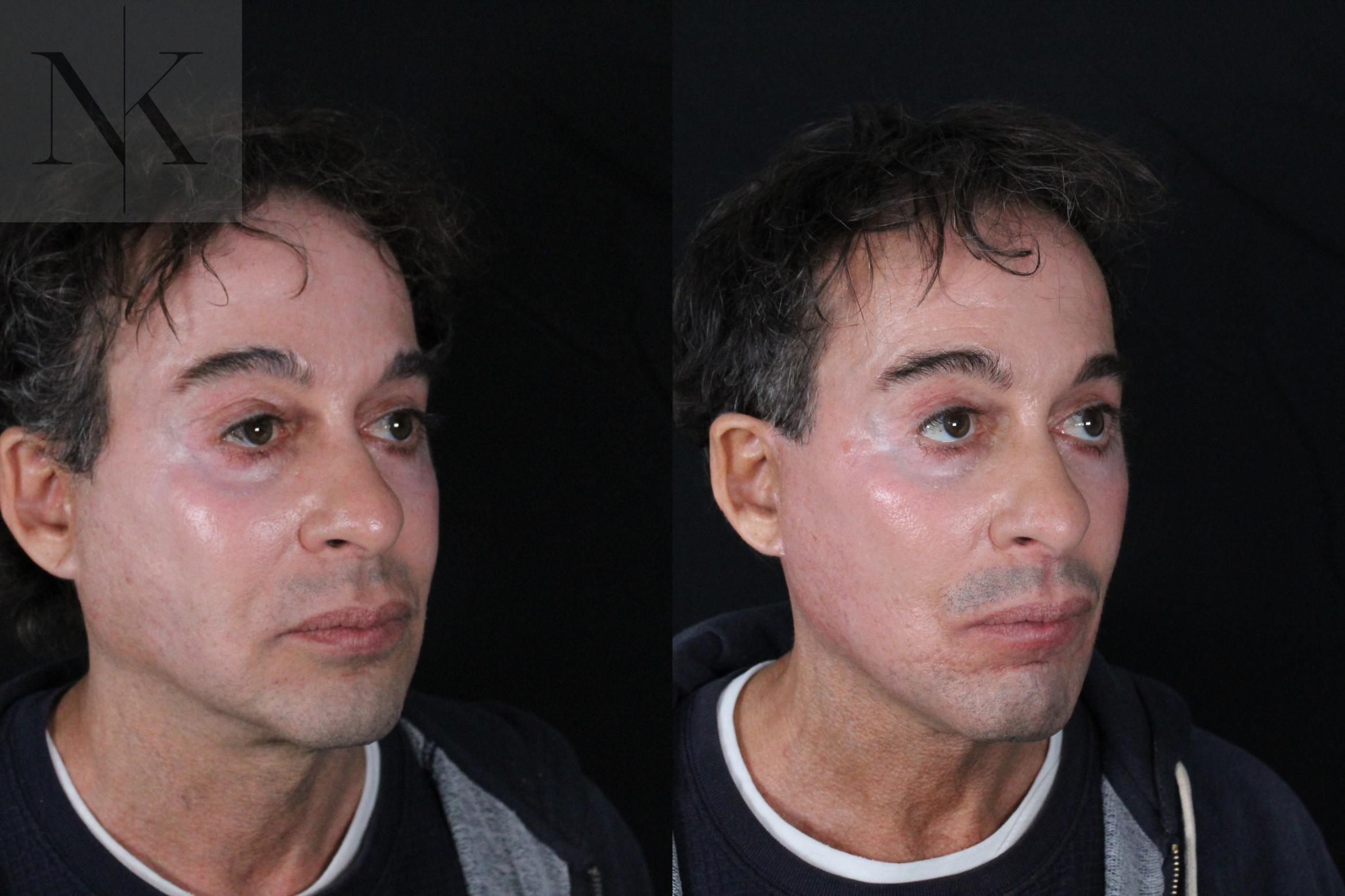 Before & After Deep Plane Facelift Case 189 Right Oblique View in Wethersfield, Hartford, Nebraska