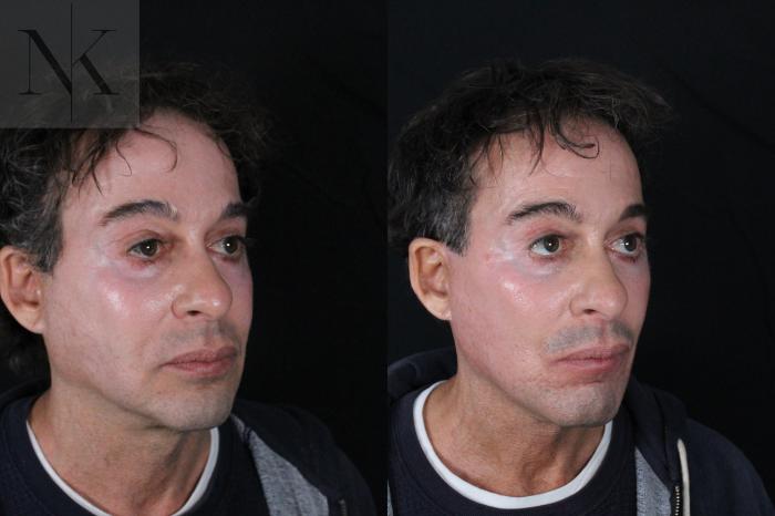 Before & After Deep Plane Facelift Case 189 Right Oblique View in Wethersfield, Hartford, Nebraska