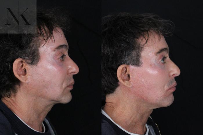 Before & After Deep Plane Facelift Case 189 Right Side View in Wethersfield, Hartford, Nebraska