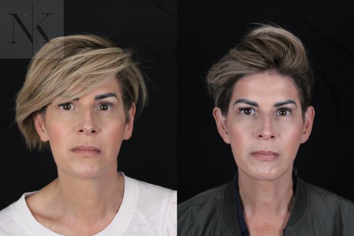 Before & After Deep Plane Facelift Case 190 Front View in Wethersfield, Hartford, Nebraska
