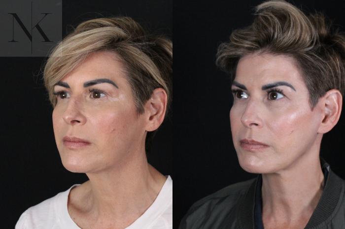 Before & After Deep Plane Facelift Case 190 Left Oblique View in Wethersfield, Hartford, Nebraska