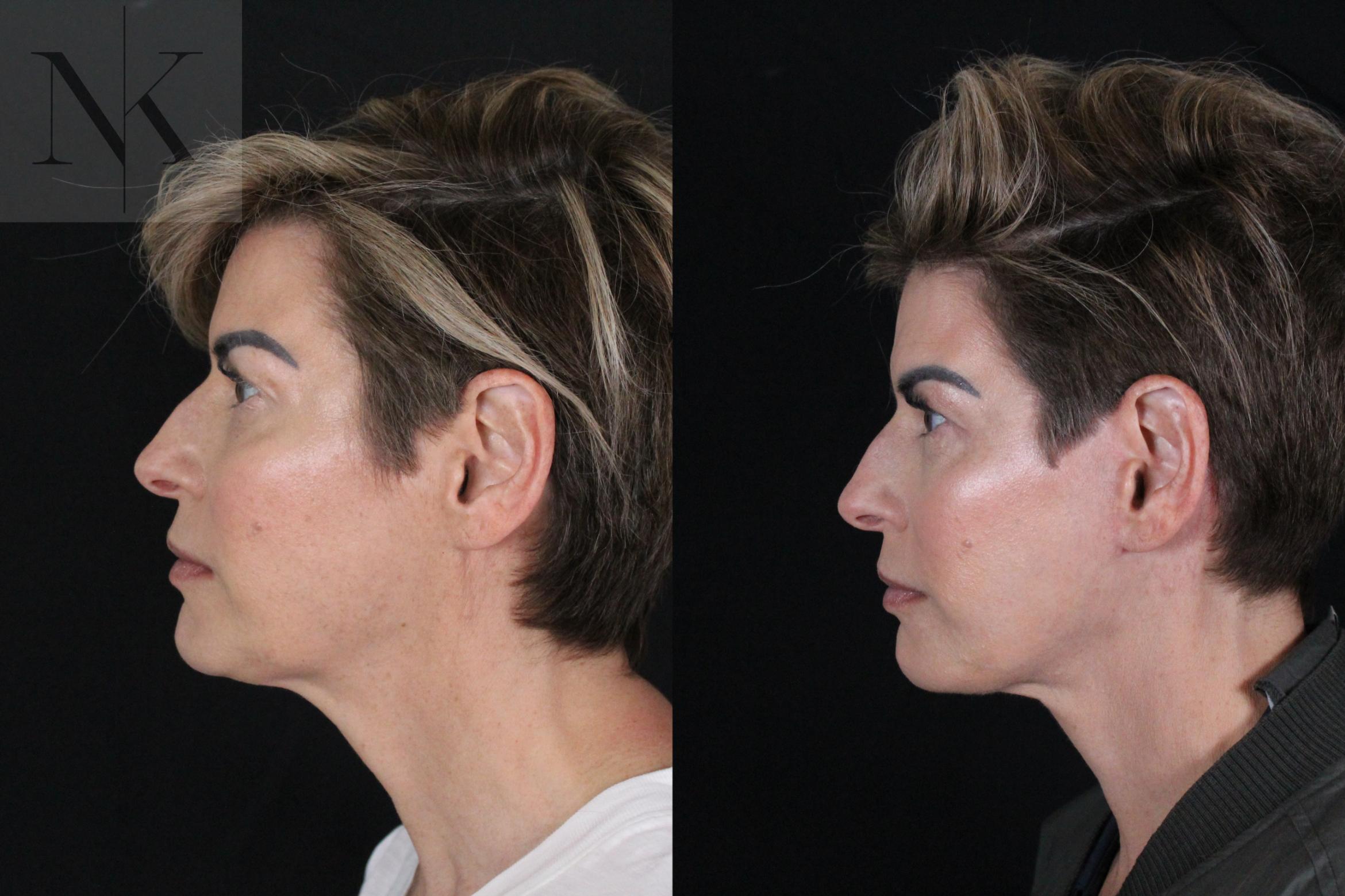 Before & After Deep Plane Facelift Case 190 Left Side View in Wethersfield, Hartford, Nebraska