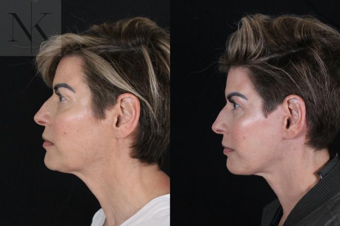Before & After Deep Plane Facelift Case 190 Left Side View in Wethersfield, Hartford, Nebraska