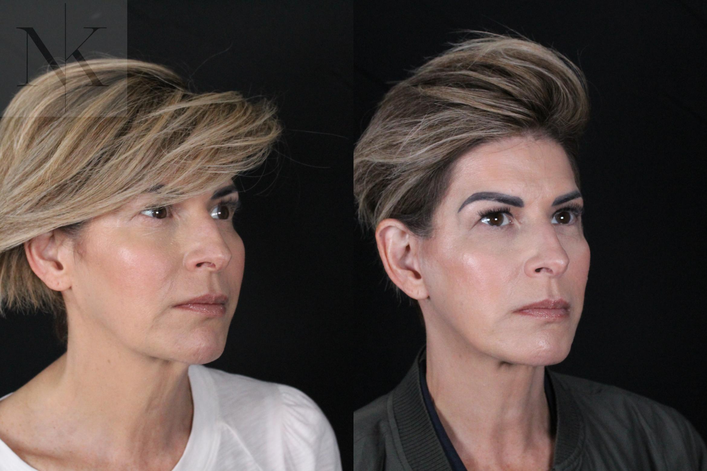 Before & After Deep Plane Facelift Case 190 Right Oblique View in Wethersfield, Hartford, Nebraska