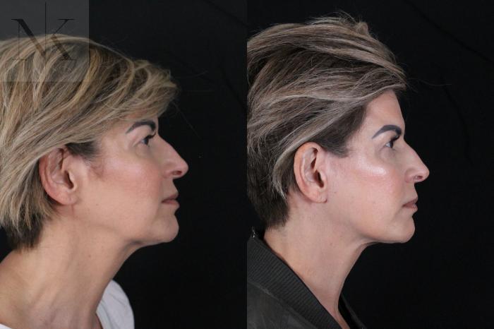 Before & After Deep Plane Facelift Case 190 Right Side View in Wethersfield, Hartford, Nebraska