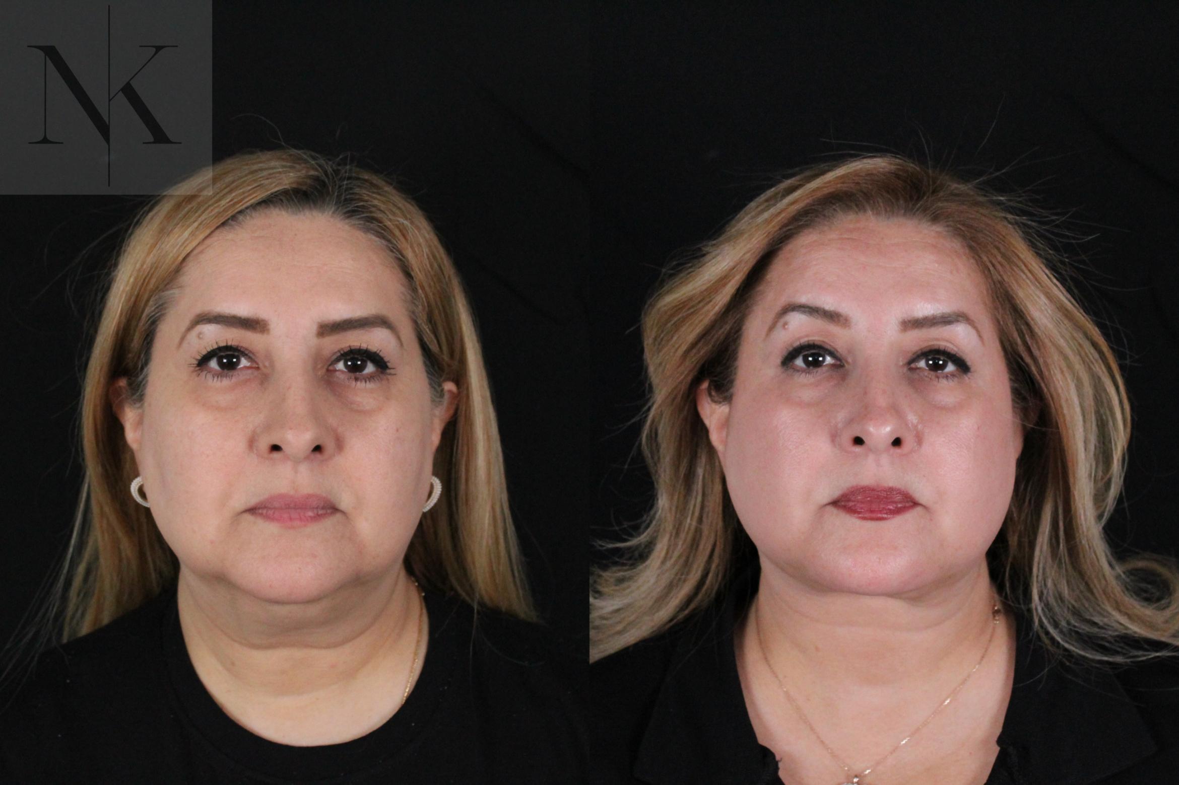 Before & After Deep Plane Facelift Case 191 Front View in Wethersfield, Hartford, Nebraska