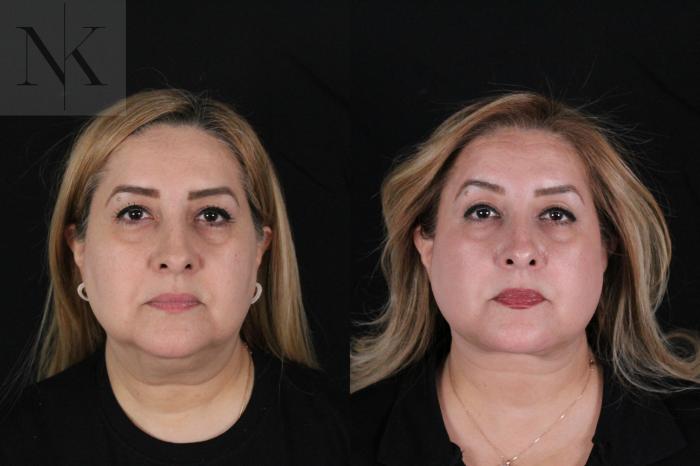 Before & After Deep Plane Facelift Case 191 Front View in Wethersfield, Hartford, Nebraska