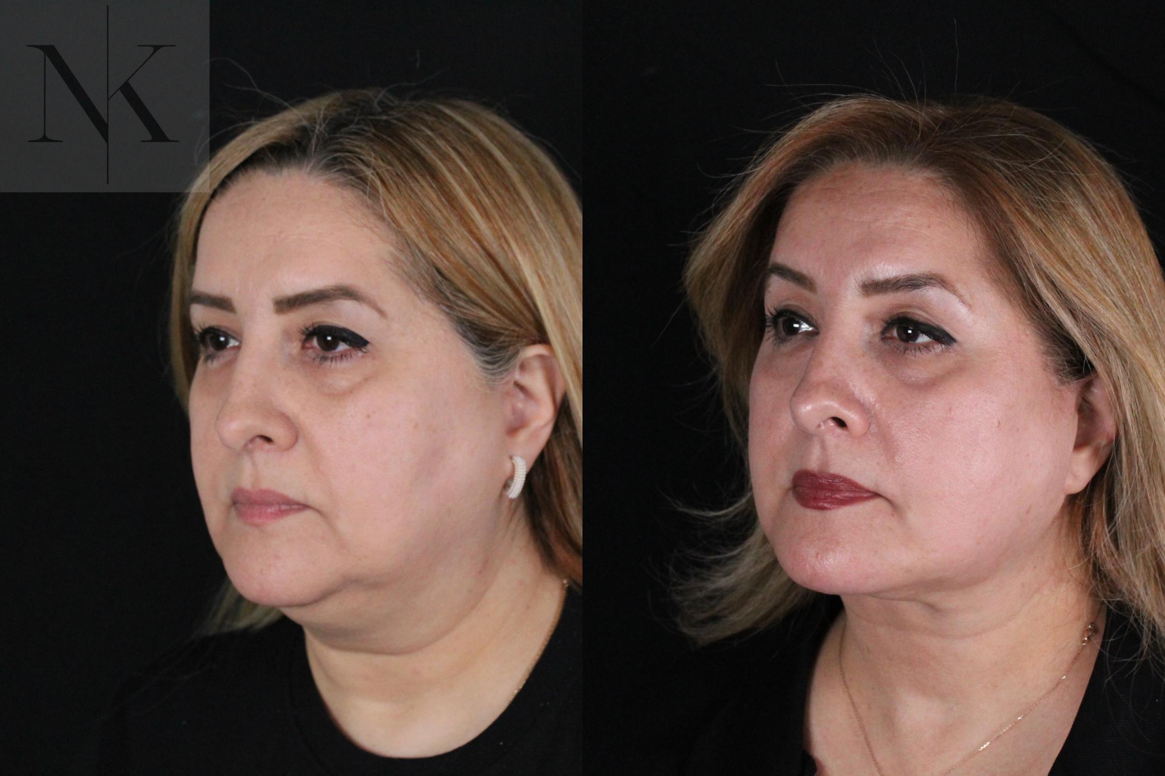 Before & After Deep Plane Facelift Case 191 Left Oblique View in Wethersfield, Hartford, Nebraska