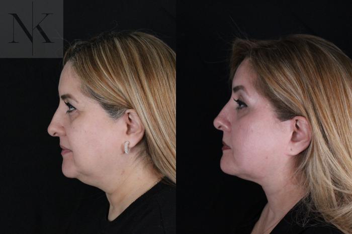 Before & After Deep Plane Facelift Case 191 Left Side View in Wethersfield, Hartford, Nebraska