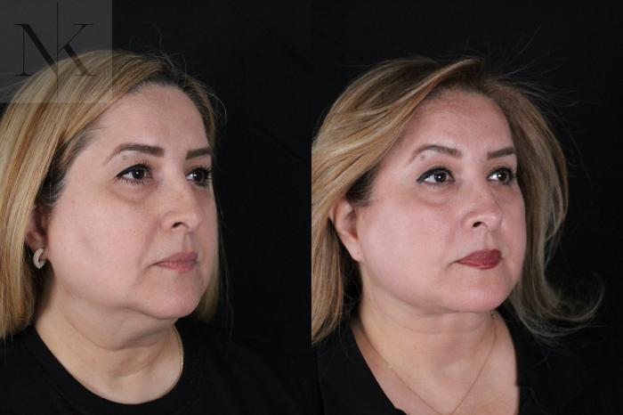 Before & After Deep Plane Facelift Case 191 Right Oblique View in Wethersfield, Hartford, Nebraska