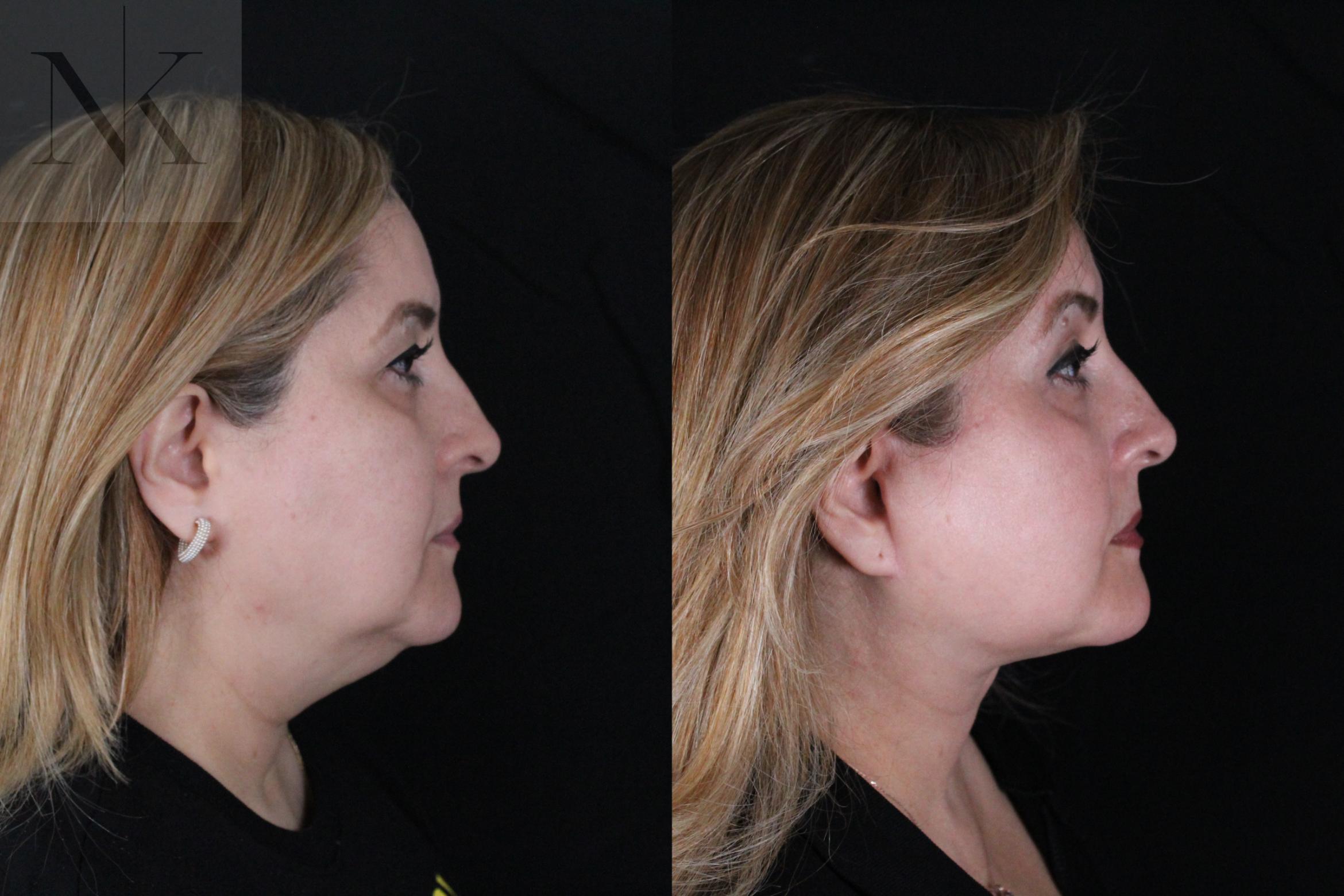 Before & After Deep Plane Facelift Case 191 Right Side View in Wethersfield, Hartford, Nebraska