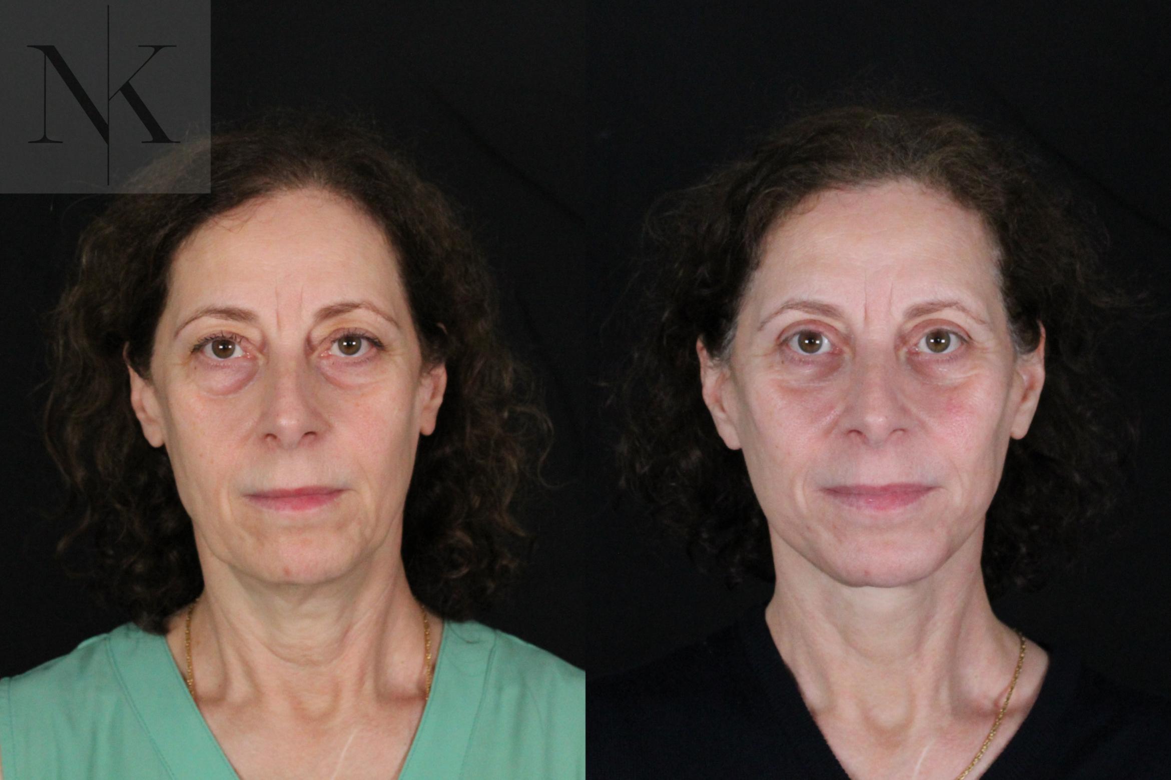 Before & After Deep Plane Facelift Case 194 Front View in Wethersfield, Hartford, Nebraska