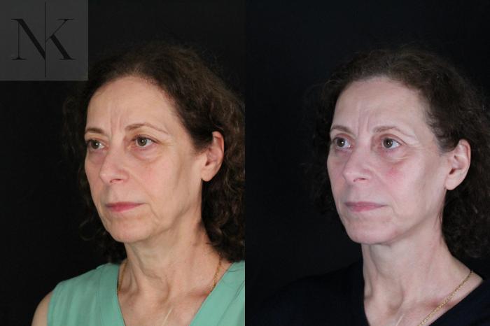 Before & After Deep Plane Facelift Case 194 Left Oblique View in Wethersfield, Hartford, Nebraska