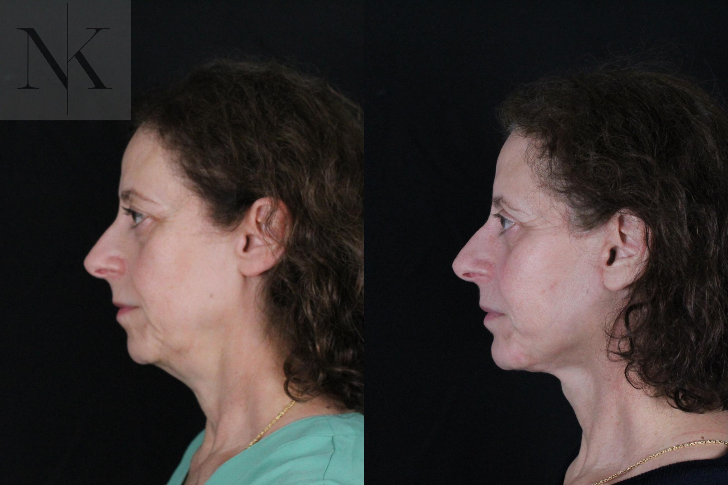 Before & After Deep Plane Facelift Case 194 Left Side View in Wethersfield, Hartford, Nebraska