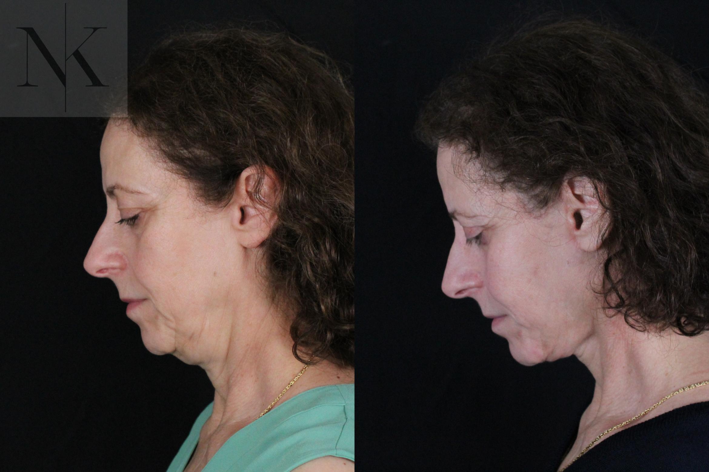 Before & After Deep Plane Facelift Case 194 Left Side Down View in Wethersfield, Hartford, Nebraska
