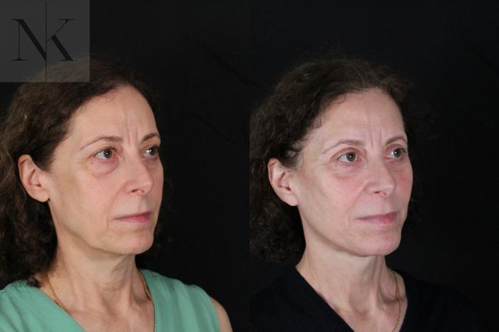 Before & After Deep Plane Facelift Case 194 Right Oblique View in Wethersfield, Hartford, Nebraska
