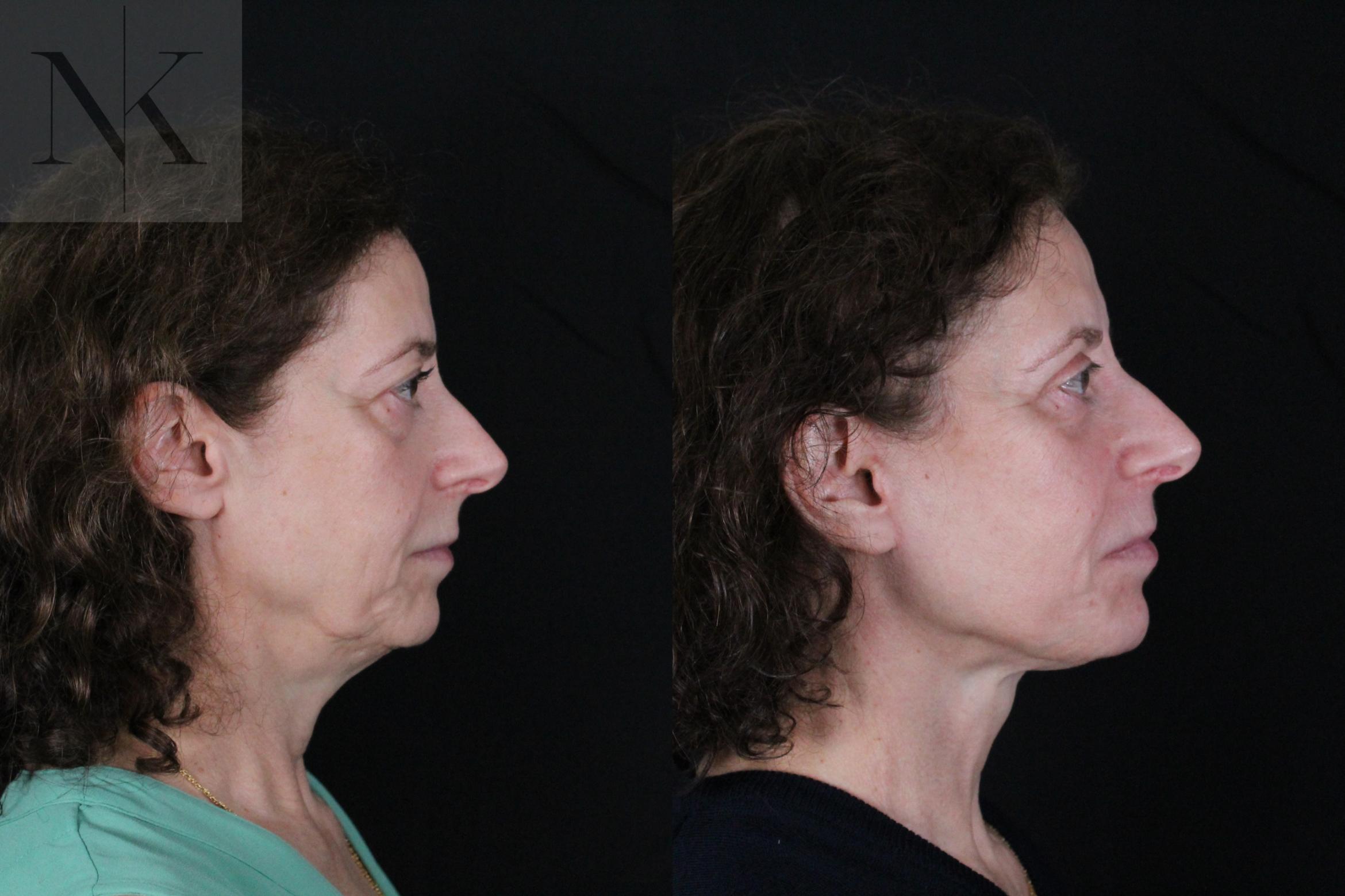 Before & After Deep Plane Facelift Case 194 Right Side View in Wethersfield, Hartford, Nebraska