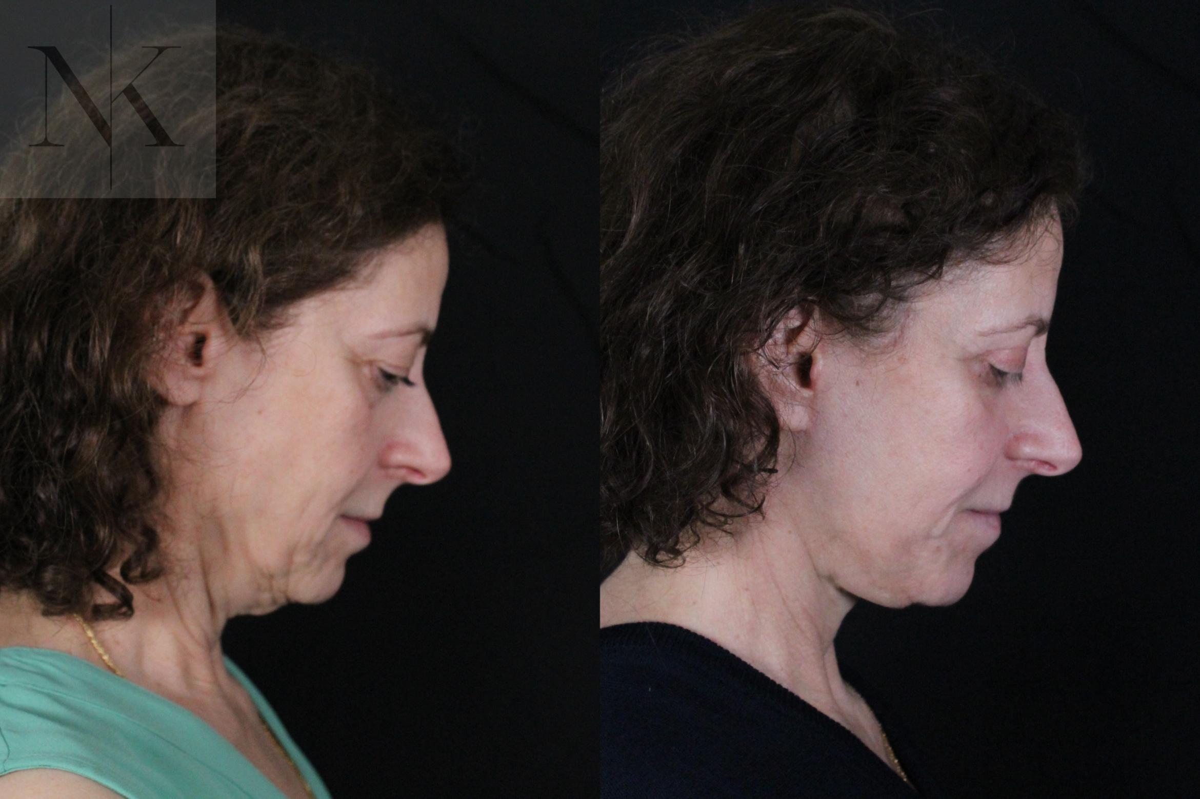 Before & After Deep Plane Facelift Case 194 Right Side Down View in Wethersfield, Hartford, Nebraska