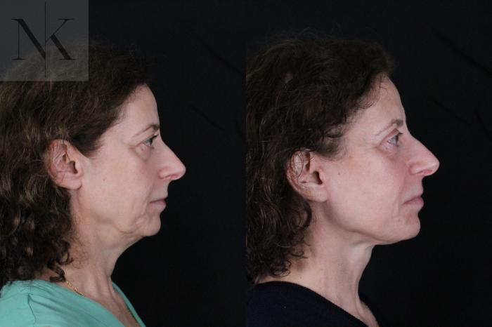Before & After Deep Plane Facelift Case 194 Right Side View in Wethersfield, Hartford, Nebraska