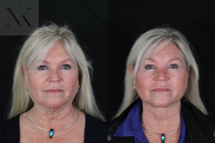 Before & After Deep Plane Facelift Case 196 Front View in Wethersfield, Hartford, Nebraska