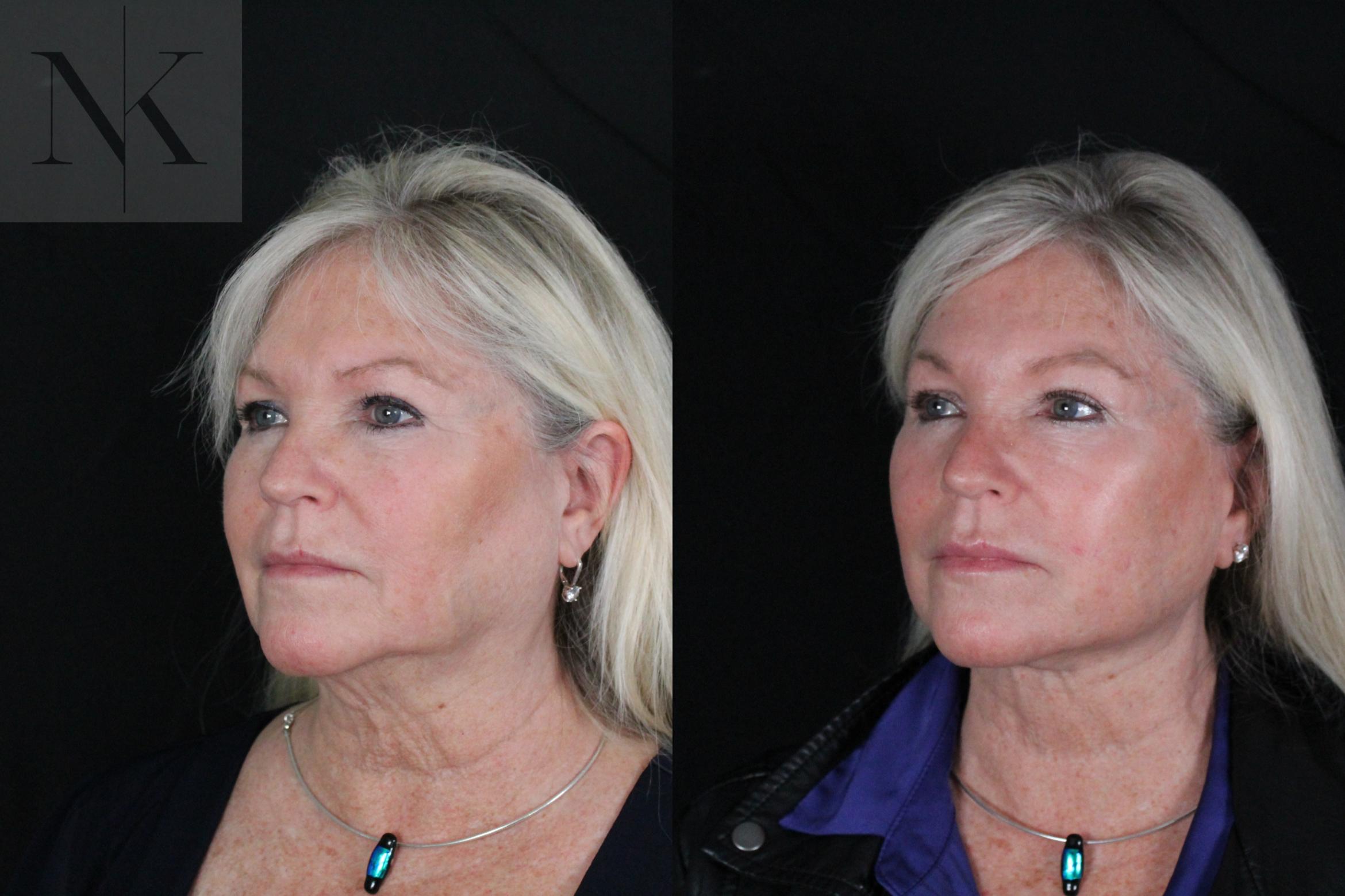 Before & After Deep Plane Facelift Case 196 Left Oblique View in Wethersfield, Hartford, Nebraska