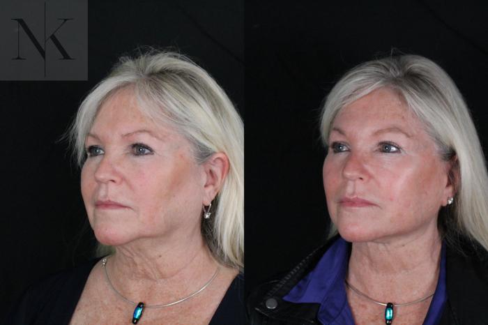 Before & After Deep Plane Facelift Case 196 Left Oblique View in Wethersfield, Hartford, Nebraska